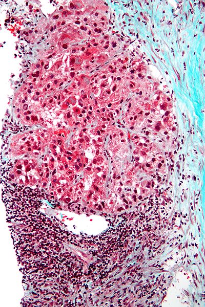 Intermediate magnification micrograph of hepatocellular carcinoma the most common form of primary liver cancer.